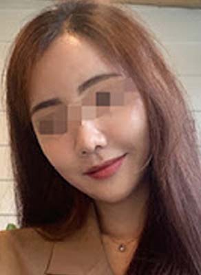 bna เคสรีวิว ศัลยกรรมขากรรไกร V-Line