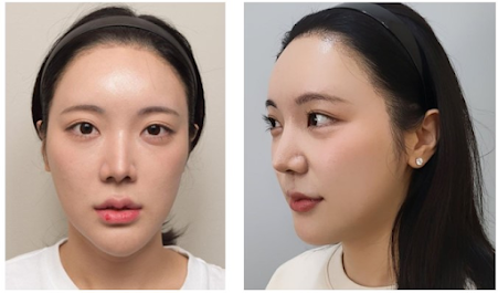 ผ่าตัดแก้โครงหน้ายาว หน้าไม่เท่ากัน กับหมอคิม eu