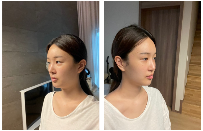 รีวิวผ่าตัดขากรรไกร จริง ที่ EU