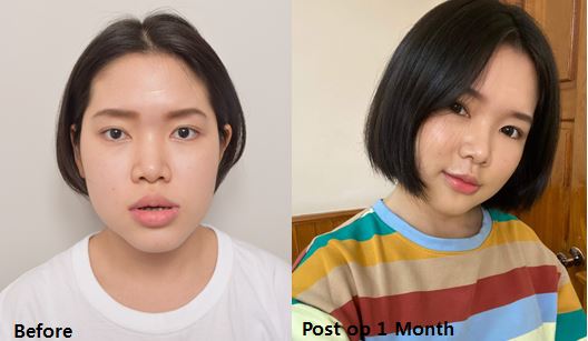 รีวิวผ่าตัดขากรรไกร สาวเมียนมาร์ ที่ eu