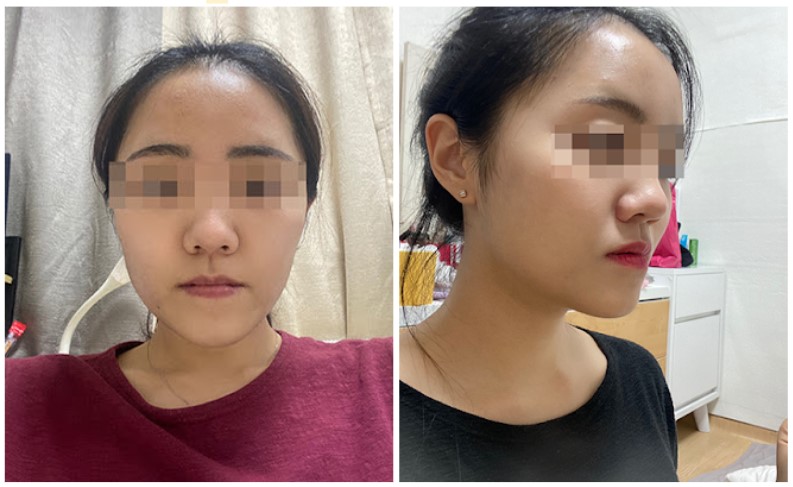 ศัลยกรรมขากรรไกร VLine ที่ EU