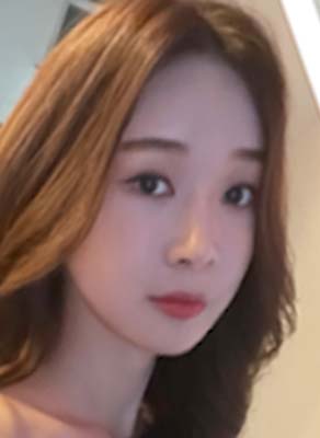 เคสรีวิว พัฒนาการเปลี่ยนแปลงหลังผ่าตัดขากรรไกร 12 เดือน