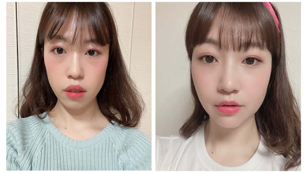 แก้ปัญหาปากยื่น คางหลุบ ยิ้มเห็นเหงือก ด้วยการผ่าตัดขากรรไกร