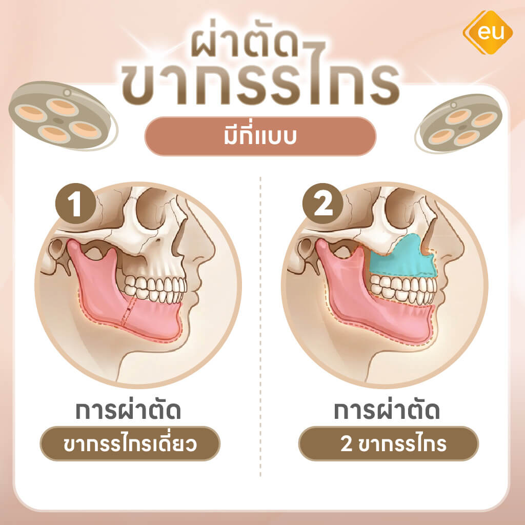การผ่าตัดขากรรไกรมีกี่แบบ