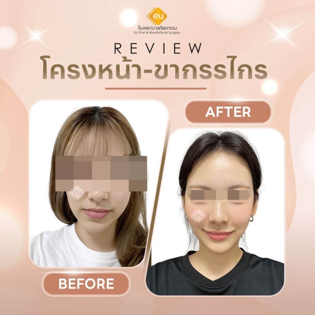 รีวิวผ่าตัดขากรรไกร ที่ eumaxillofacial