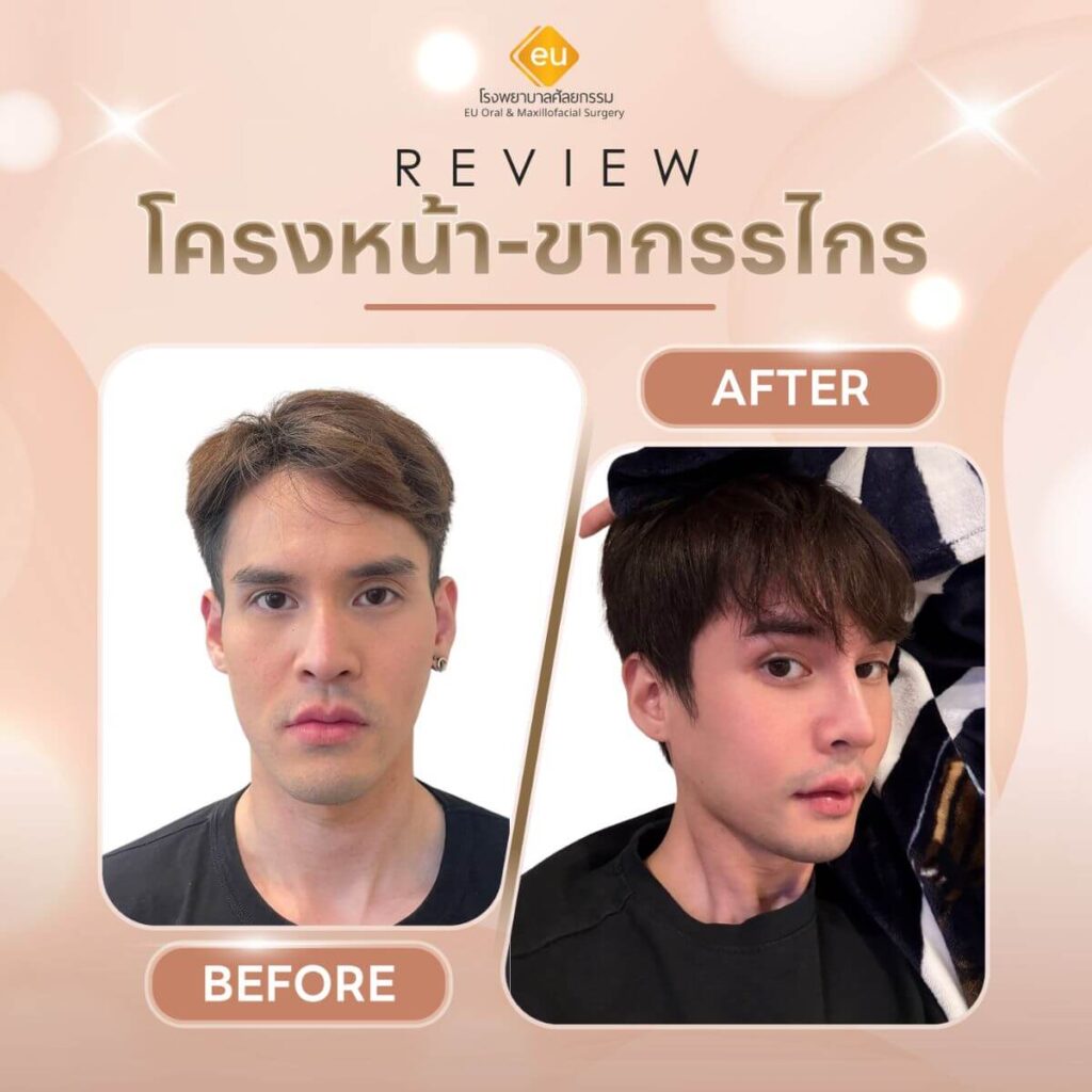 รีวิวผ่าตัดขากรรไกร ผู้ชาย