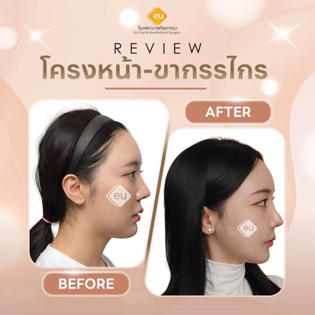 รีวิวผ่าตัดขากรรไกร เกาหลี