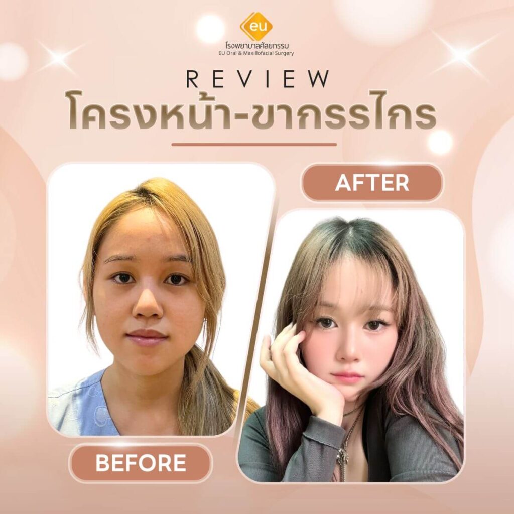 รีวิวผ่าตัดขากรรไกร เคสคนไทย