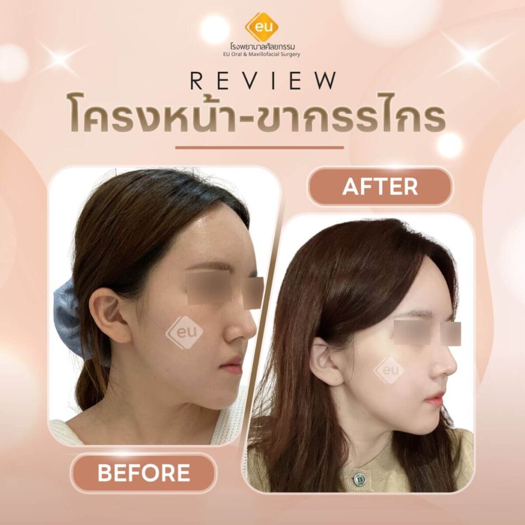 รีวิวผ่าตัดขากรรไกร โรงพยาบาล Eu