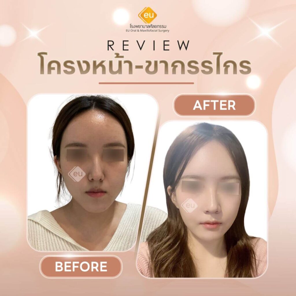 รีวิวศัลยกรรม โครงหน้า ขากรรไกร Eu