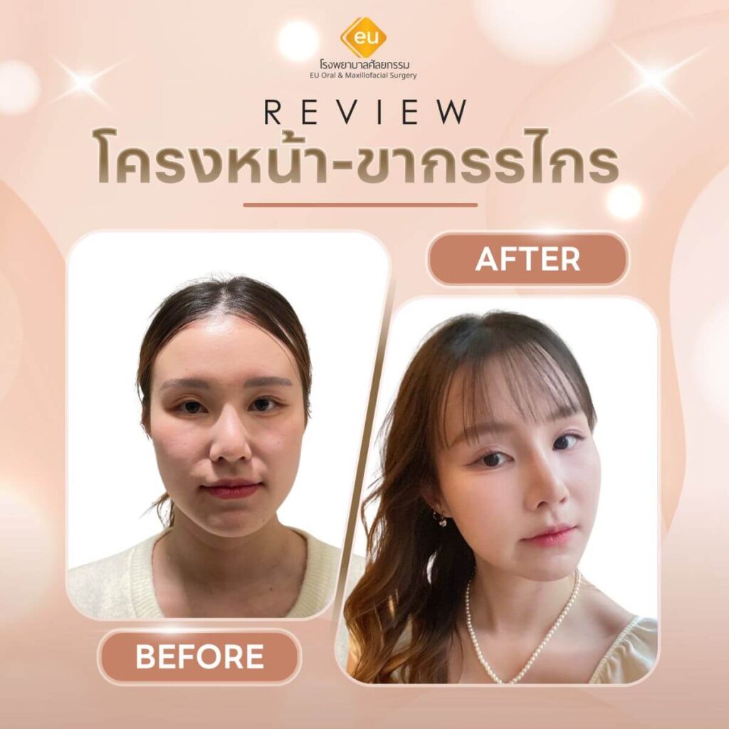 รีวิวโครงหน้าขากรรไกร